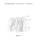 Subcutaneous Cardiac Sensing and Stimulation System diagram and image