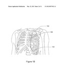 Subcutaneous Cardiac Sensing and Stimulation System diagram and image