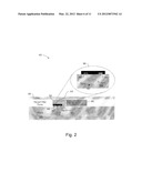 Subcutaneous Cardiac Sensing and Stimulation System diagram and image