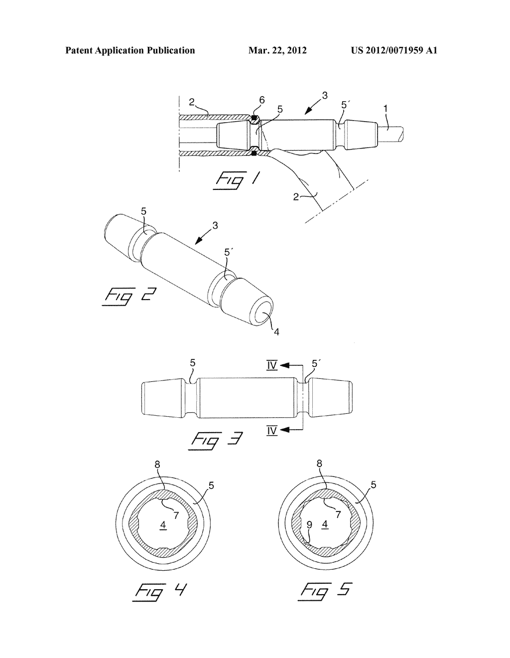 SUTURE SLEEVE AND A METHOD FOR MANUFACTURING A SUTURE SLEEVE - diagram, schematic, and image 02