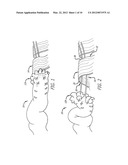 DEVICE AND METHOD FOR ASSISTING IN FLEXOR TENDON REPAIR AND REHABILITATION diagram and image