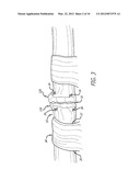 DEVICE AND METHOD FOR ASSISTING IN FLEXOR TENDON REPAIR AND REHABILITATION diagram and image