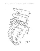 BONE GRAFTS diagram and image