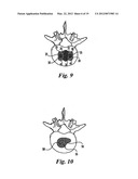 BONE GRAFTS diagram and image