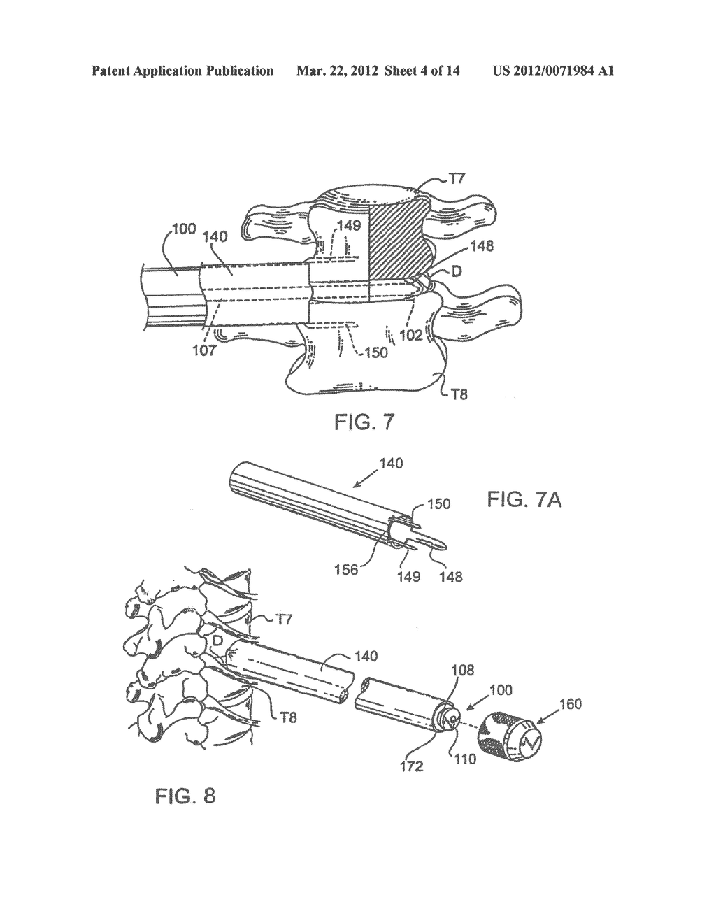 METHOD FOR INSERTING AN ARTIFICIAL IMPLANT BETWEEN TWO ADJACENT VERTEBRAE     ALONG A CORONAL PLANE - diagram, schematic, and image 05