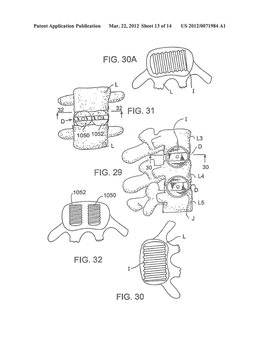 METHOD FOR INSERTING AN ARTIFICIAL IMPLANT BETWEEN TWO ADJACENT VERTEBRAE     ALONG A CORONAL PLANE - diagram, schematic, and image 14