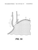 TISSUES PATCHES AND RELATED DELIVERY SYSTEMS AND METHODS diagram and image