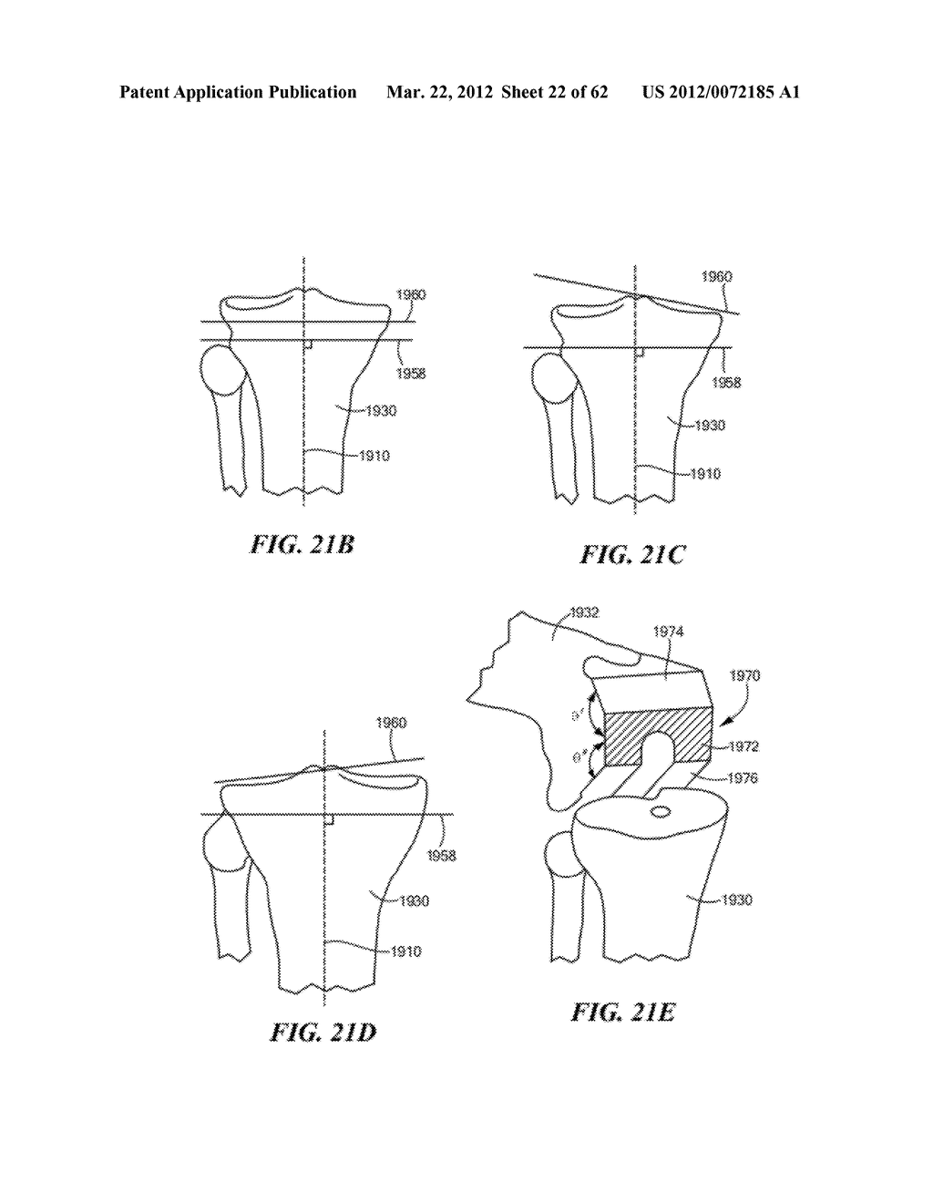 PATIENT SELECTABLE JOINT ARTHROPLASTY DEVICES AND SURGICAL TOOLS - diagram, schematic, and image 23