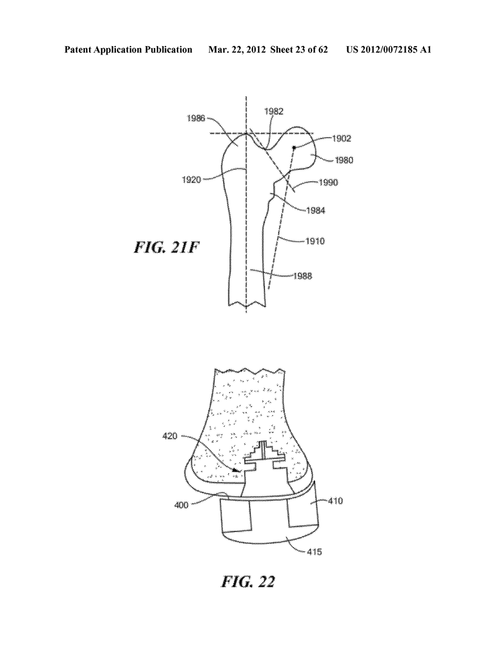 PATIENT SELECTABLE JOINT ARTHROPLASTY DEVICES AND SURGICAL TOOLS - diagram, schematic, and image 24