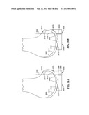 PATIENT SELECTABLE JOINT ARTHROPLASTY DEVICES AND SURGICAL TOOLS diagram and image