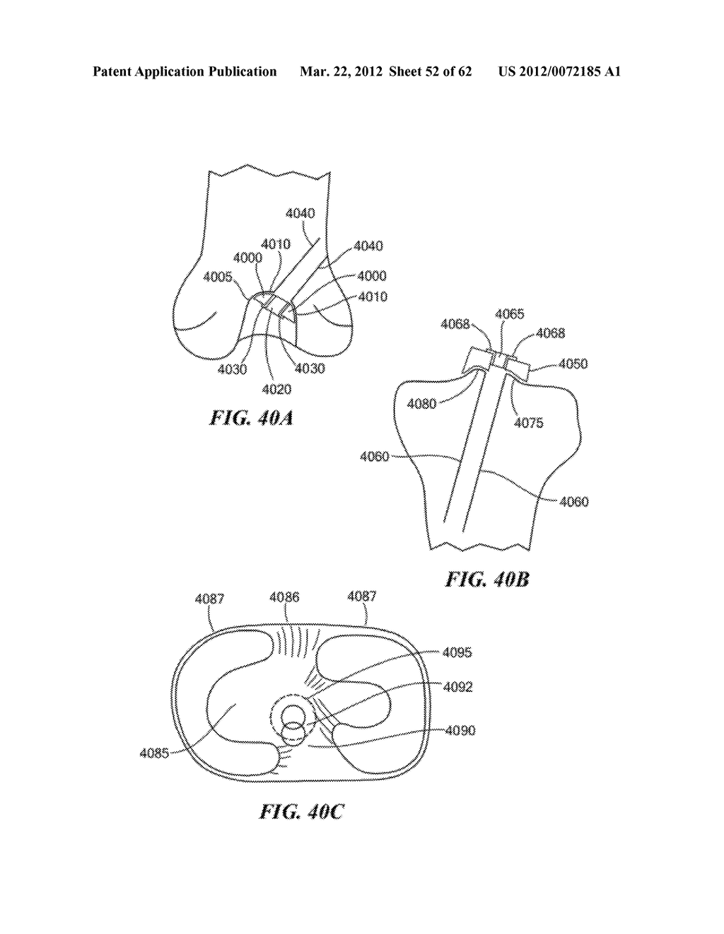 PATIENT SELECTABLE JOINT ARTHROPLASTY DEVICES AND SURGICAL TOOLS - diagram, schematic, and image 53