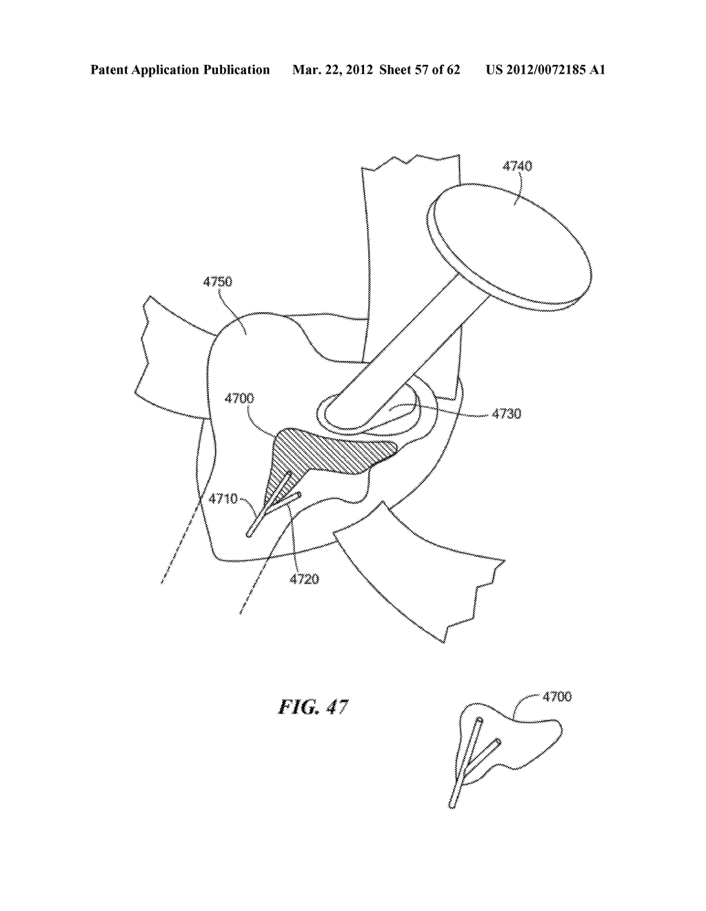 PATIENT SELECTABLE JOINT ARTHROPLASTY DEVICES AND SURGICAL TOOLS - diagram, schematic, and image 58