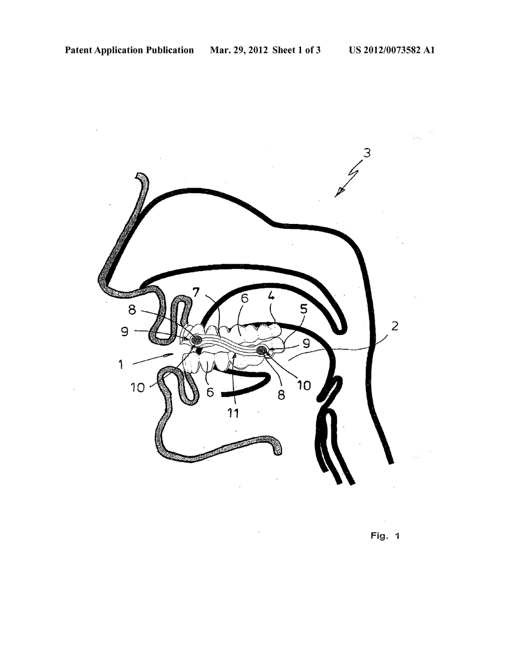 ANTI-SNORING DEVICE - diagram, schematic, and image 02