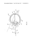 OCULAR RADIOSURGERY diagram and image