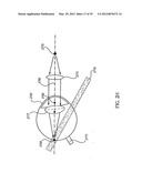 OCULAR RADIOSURGERY diagram and image