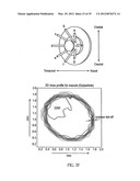 OCULAR RADIOSURGERY diagram and image