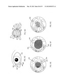 OCULAR RADIOSURGERY diagram and image