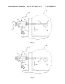 Tissue Localization Device and Method diagram and image