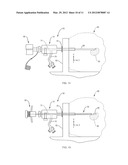 Tissue Localization Device and Method diagram and image