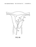 METHODS AND SYSTEMS FOR CONTROLLED DEPLOYMENT OF NEEDLES IN TISSUE diagram and image