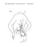 ELEMENT FOR IMPLANTATION WITH MEDICAL DEVICE diagram and image