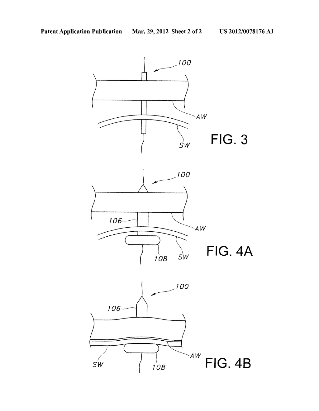 Multi-Balloon Dilation Device for Placing Catheter Tubes - diagram, schematic, and image 03