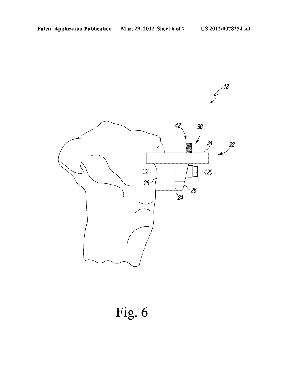 CUSTOMIZED PATIENT-SPECIFIC COMPUTER CONTROLLED CUTTING SYSTEM AND METHOD - diagram, schematic, and image 07