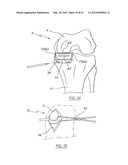 METHOD OF ARTHROPLASTY ON A KNEE JOINT AND APPARATUS FOR USE IN SAME diagram and image