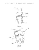 METHOD OF ARTHROPLASTY ON A KNEE JOINT AND APPARATUS FOR USE IN SAME diagram and image