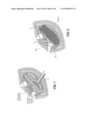 ABSORBABLE FASTENER AND APPLYING APPARATUS diagram and image