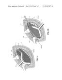 ABSORBABLE FASTENER AND APPLYING APPARATUS diagram and image