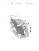 ABSORBABLE FASTENER AND APPLYING APPARATUS diagram and image