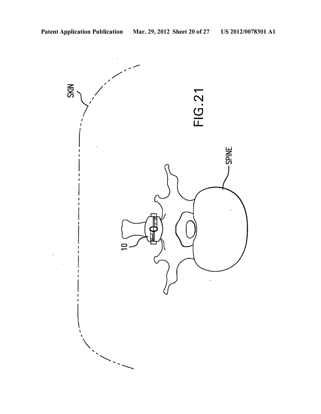 INTERSPINOUS IMPLANTS AND METHODS FOR IMPLANTING SAME - diagram, schematic, and image 21