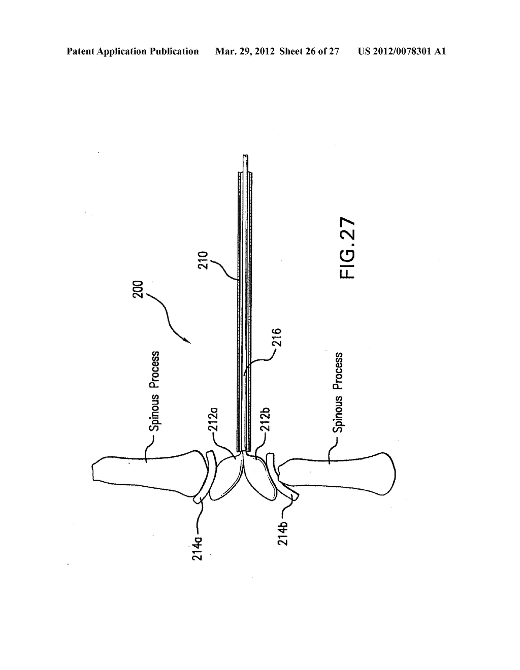 INTERSPINOUS IMPLANTS AND METHODS FOR IMPLANTING SAME - diagram, schematic, and image 27