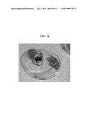 NANOPARTICULATE IN-SITU GELS AS VITREOUS HUMOR SUBSTITUTES FOR OCULAR     DISEASES diagram and image