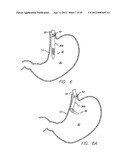 Remote Tissue Retraction Device diagram and image