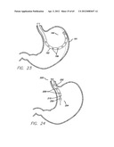 Remote Tissue Retraction Device diagram and image