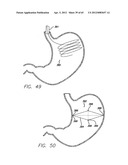 Remote Tissue Retraction Device diagram and image