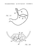 Remote Tissue Retraction Device diagram and image