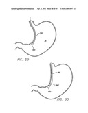 Remote Tissue Retraction Device diagram and image