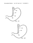 Remote Tissue Retraction Device diagram and image