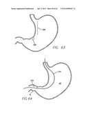 Remote Tissue Retraction Device diagram and image