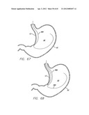 Remote Tissue Retraction Device diagram and image