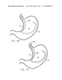 Remote Tissue Retraction Device diagram and image