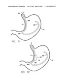 Remote Tissue Retraction Device diagram and image