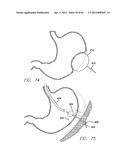 Remote Tissue Retraction Device diagram and image