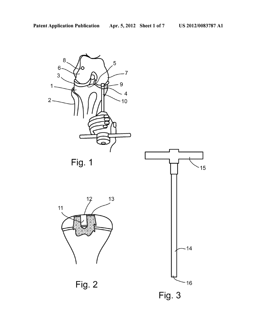 IMPLEMENT FOR ORIENTATING A TOOL, PARTICULARLY USEFUL IN SURGICAL TOOLS     FOR HARVESTING AND IMPLANTING BONE PLUGS TO REPAIR DAMAGED BONE TISSUE - diagram, schematic, and image 02