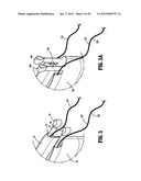 SURGICAL RETRIEVAL APPARATUS diagram and image