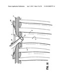 SURGICAL RETRIEVAL APPARATUS diagram and image