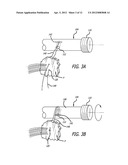 SYSTEM AND METHOD FOR FACILITATING REPAIR AND REATTACHMENT OF COMMINUTED     BONE PORTIONS diagram and image